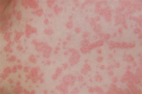 Allergic erythema multiforme reaction to amoxicillin in children and
