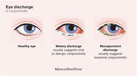 Understanding Allergy Pink Eye: Causes, Symptoms, and Effective Treatments