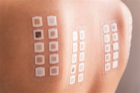 Allergy Testing Instructions