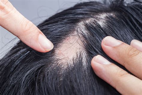 Alopecia Areata Stress Management