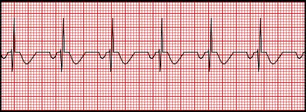 alternating current interference ecg