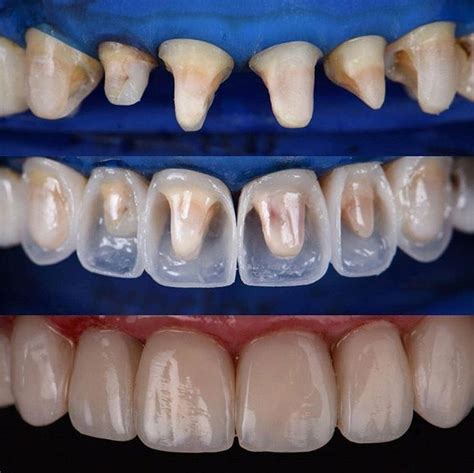 Alternative To Veneers