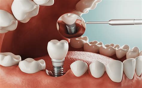 alternatives to dental implant surgery