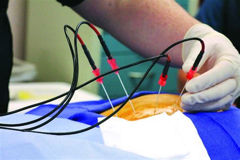 alternatives to radiofrequency ablation