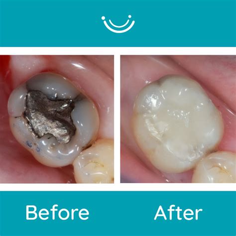 Amalgam Fillings Good