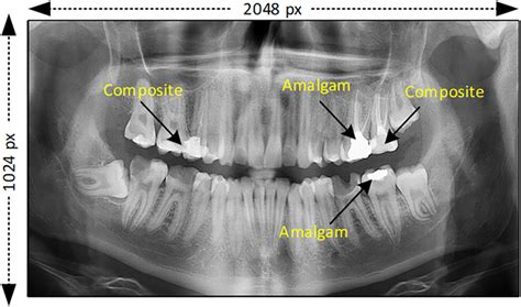 Amalgam In Xray