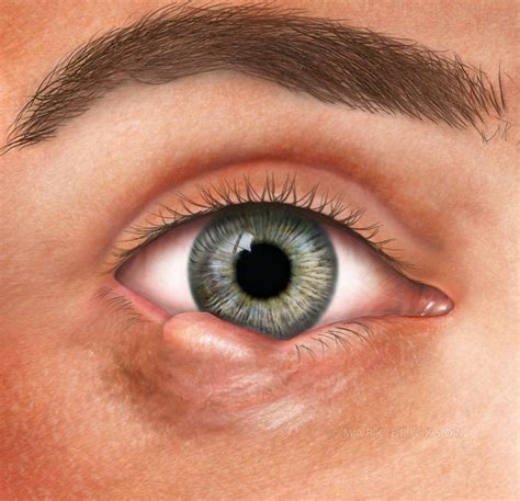 amelanotic melanoma of the eye