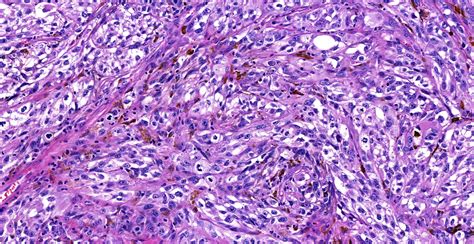 amelanotic melanoma pathology outlines