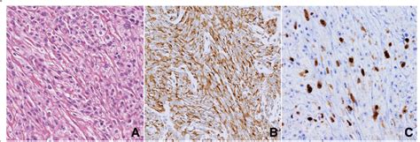 amelanotic spindle cell melanoma