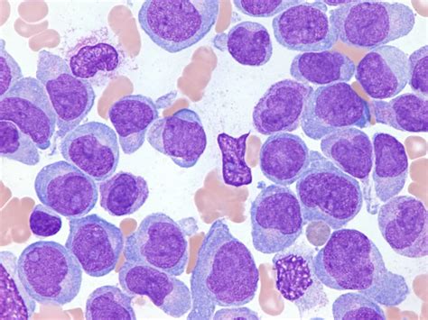 aml acute leukemia