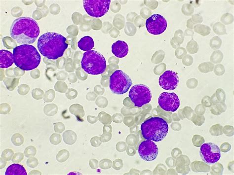 aml type leukemia