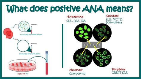 Understanding What ANA Test Positive Results Really Mean