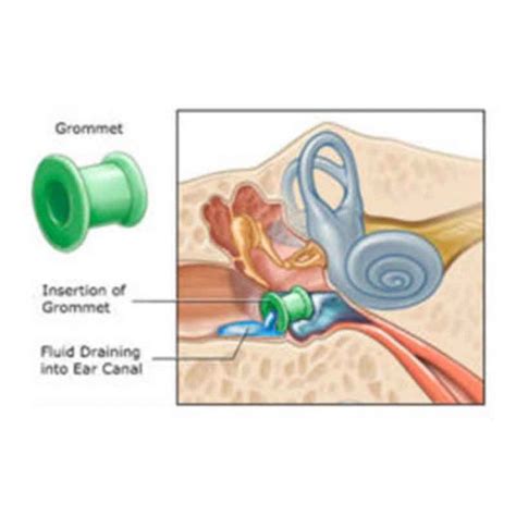Anaesthesia For Grommet Insertion