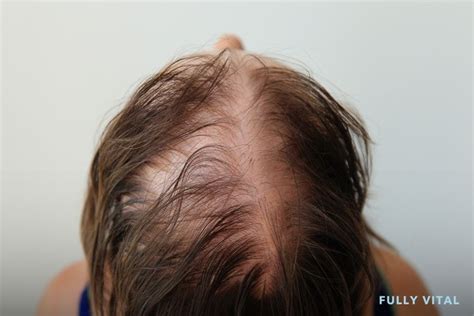 Anagen Cassara Minoxidil: The Solution for Hair Loss