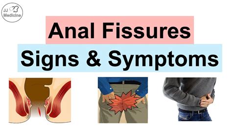 Understanding Anal Fissures Symptoms: What You Need to Know About Causes and Relief Options