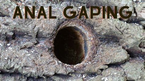 anal gaping
