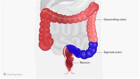 anastomosis in the sigmoid colon