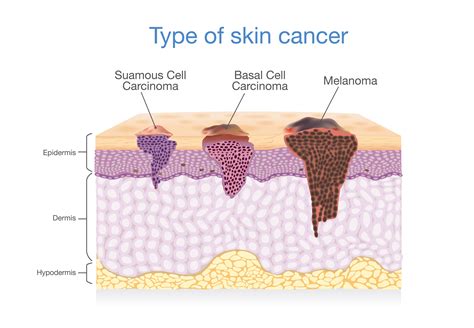 anatomy of the skin with melanoma