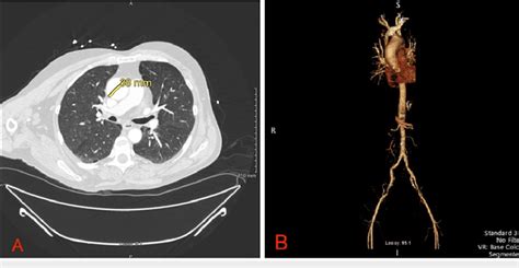Understanding Angiogram CT Chest: A Diagnostic Imaging Breakthrough