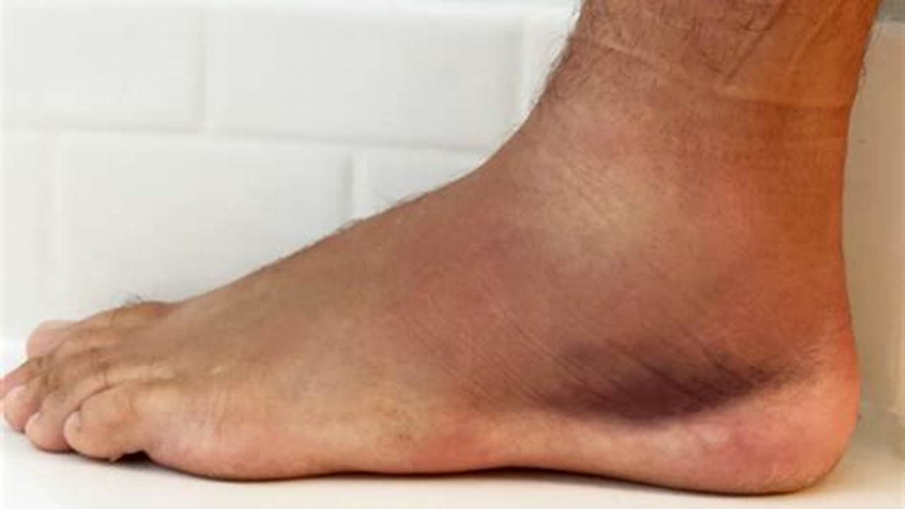 Ankle Sprain Still Hurts After 6 Months