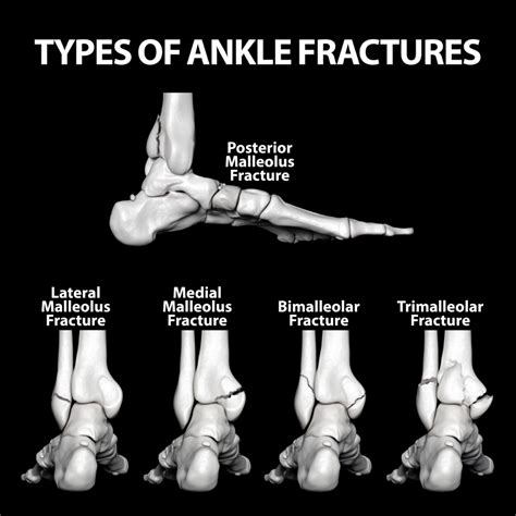 Understanding Common Ankle Fracture Types and Treatment Options