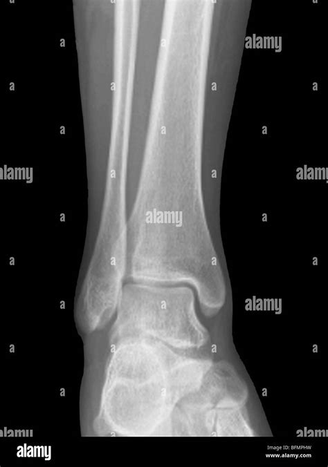 ankle joint x ray