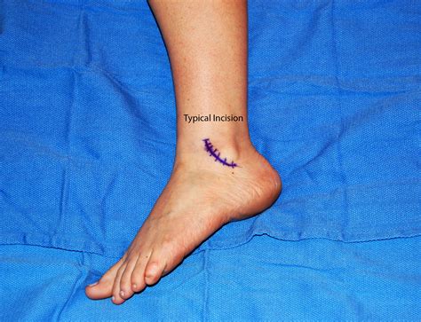 ankle ligament repair surgery recovery