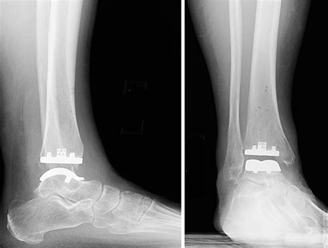 Say Goodbye to Ankle Pain: What You Need to Know About Ankle Replacement Surgery