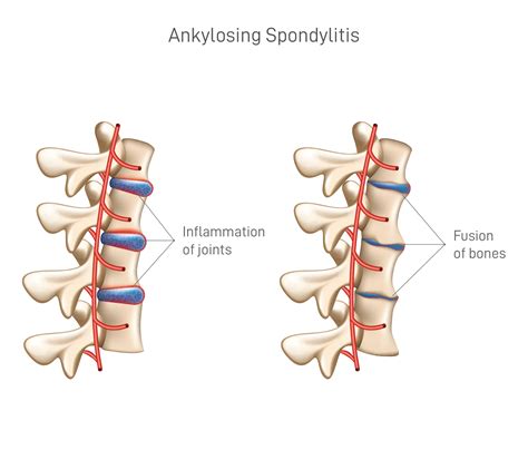 ankylosing spondylitis en espanol