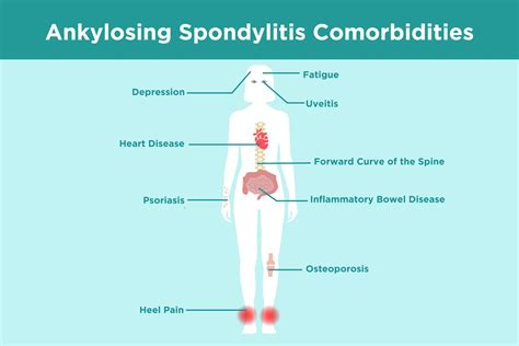 ankylosing spondylitis new research
