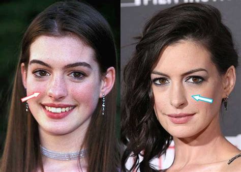 anne hathaway before after