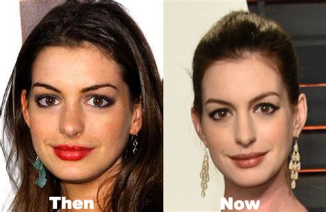 anne hathaway plastic surgery before after