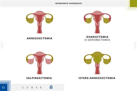 annessiectomia bilaterale laparoscopica