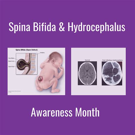another name for spina bifida