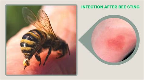 anoxic bee sting