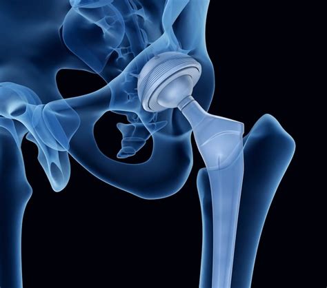 anterior approach hip replacement mayo clinic