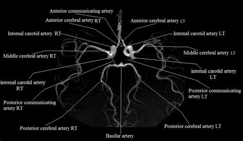 anterior cerebral artery radiology