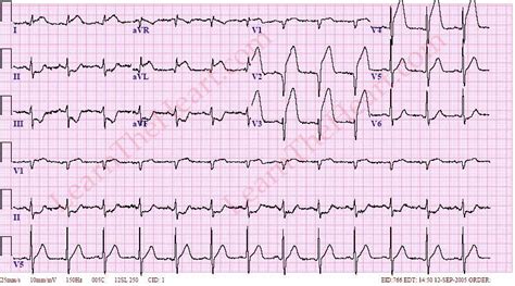 anteroseptal infarct icd 10