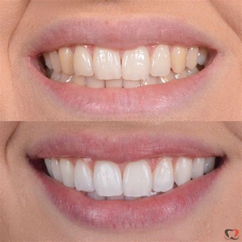 antes e depois de clareamento dental