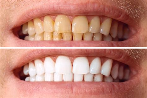 antes e depois dentes