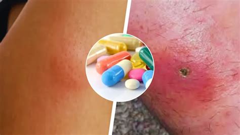 Effective Antibiotics for Spider Bite Treatment: What You Need to Know