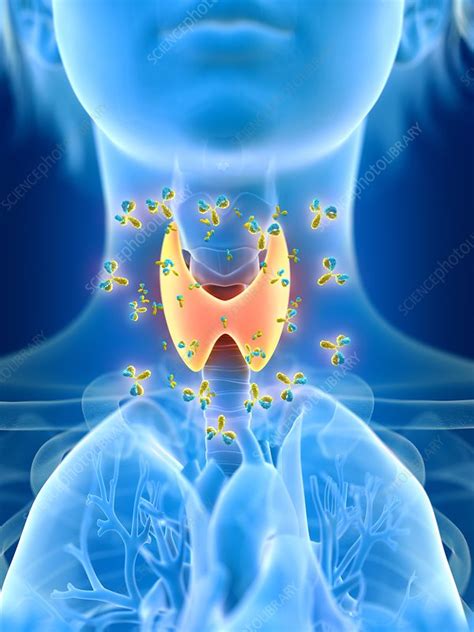 Antibodies Attack Thyroid Gland