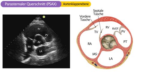Aortenklappenstenose EKG & ECHO