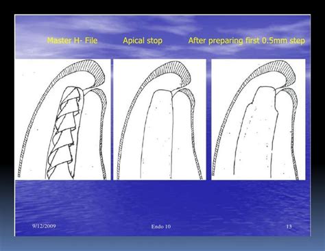 Apical Stop Root Canal