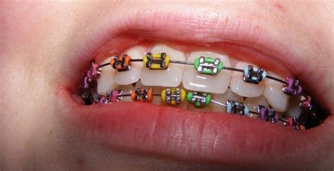 Appareils dentaire mobiles en orthodontie fonctionnelle.