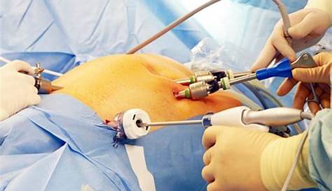 Appendix Laparoscopic Surgery Scars Incision And Scar At Navel After Appendectomy