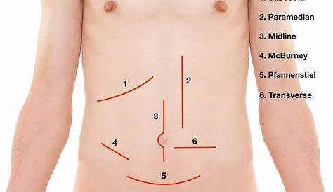Appendix Operation Marks Abdominal Scar For Appendectomy Stock Image C002/9666