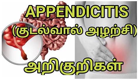 Appendix Operation Meaning In Tamil Abdominal Surgery Cost Tags Archives LogintoHealth