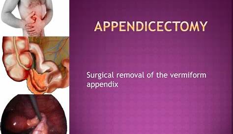Appendix Operation Video Free Download Laparoscopic Appendectomy Standard Technique (realtime