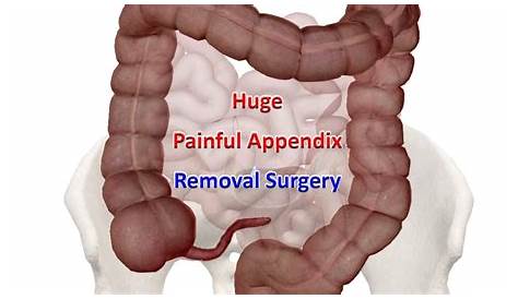 AppendicectomyLaparoscopic method and steps YouTube